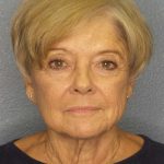 Facelift Before & After Patient #11683