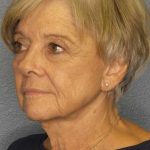 Facelift Before & After Patient #11683