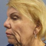 Facelift Before & After Patient #7573