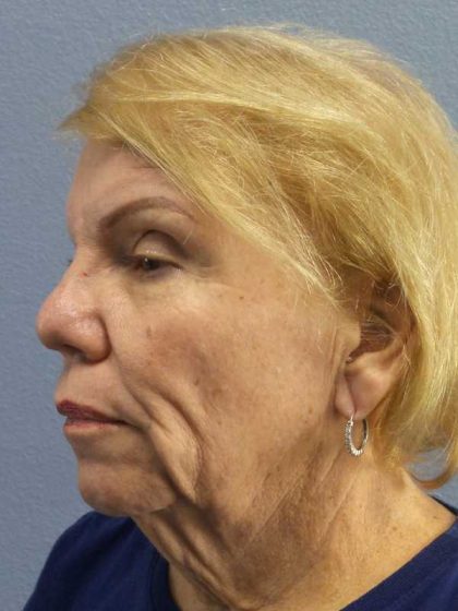 Facelift Before & After Patient #7573