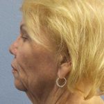 Facelift Before & After Patient #7573