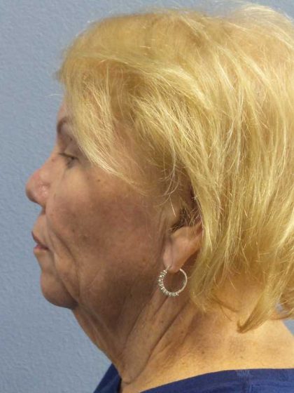 Facelift Before & After Patient #7573