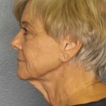 Facelift Before & After Patient #11683