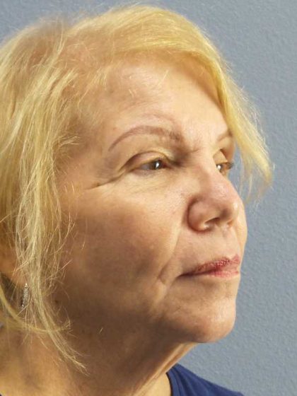 Facelift Before & After Patient #7573