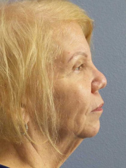 Facelift Before & After Patient #7573