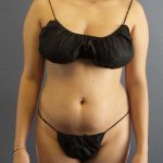Brazilian Butt Lift Before & After Patient #11305