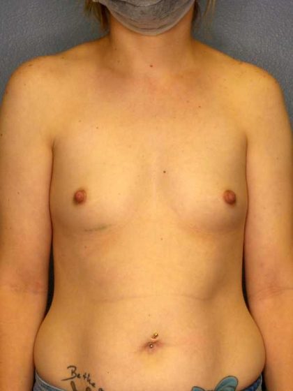 Breast Augmentation Before & After Patient #11573