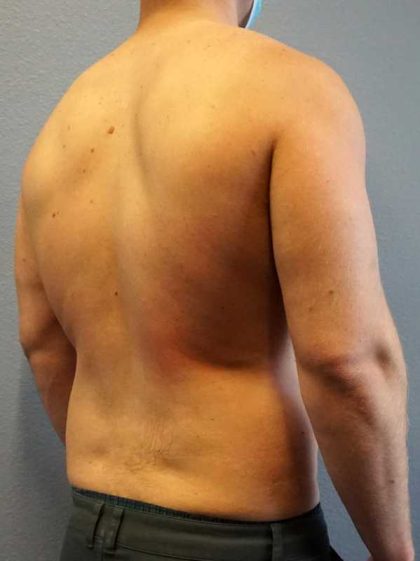 Male Liposuction Before & After Patient #8201