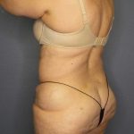 High BMI (Larger Patients) Surgery Before & After Patient #10444