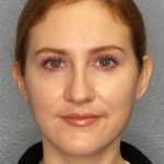 Rhinoplasty Before & After Patient #11013