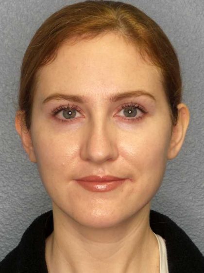 Rhinoplasty Before & After Patient #11013