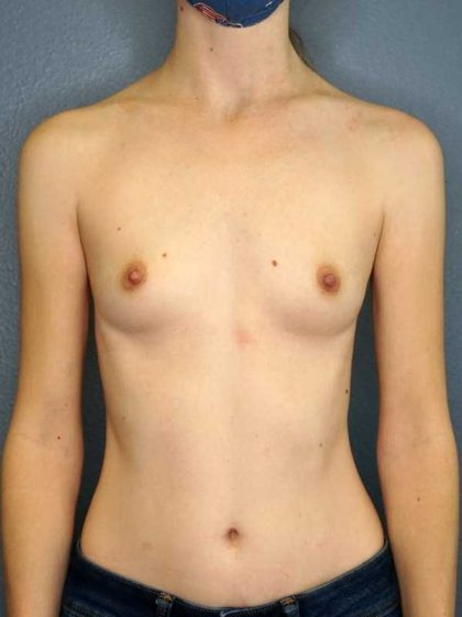 Breast Augmentation Before & After Patient #11498