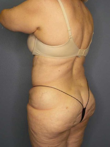 High BMI (Larger Patients) Surgery Before & After Patient #10444