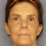 Resurfacing Before & After Patient #12297