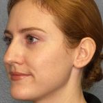 Rhinoplasty Before & After Patient #11013