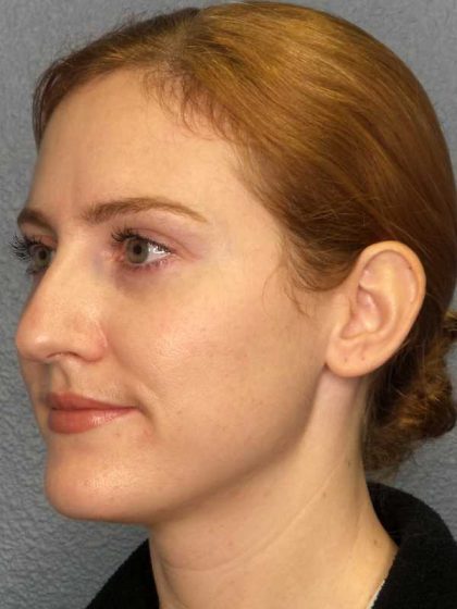 Rhinoplasty Before & After Patient #11013