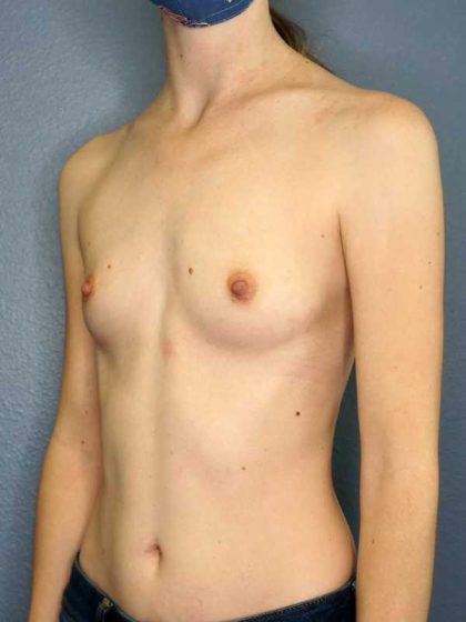 Breast Augmentation Before & After Patient #11498