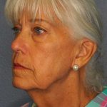 Facelift Before & After Patient #11892