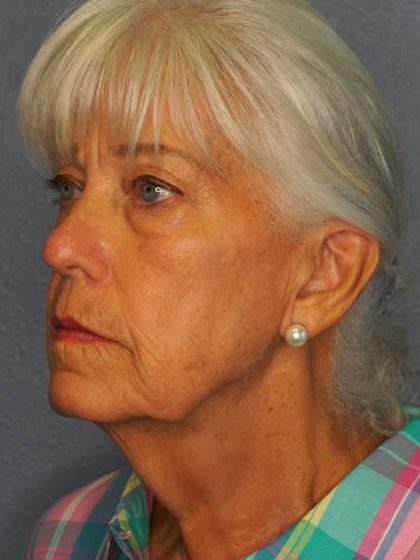 Facelift Before & After Patient #11892