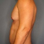 Male Liposuction Before & After Patient #8201