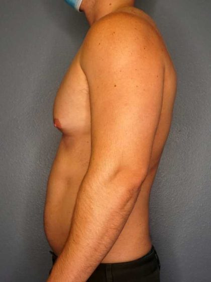 Male Liposuction Before & After Patient #8201