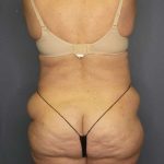 High BMI (Larger Patients) Surgery Before & After Patient #10444