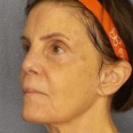 Resurfacing Before & After Patient #12297
