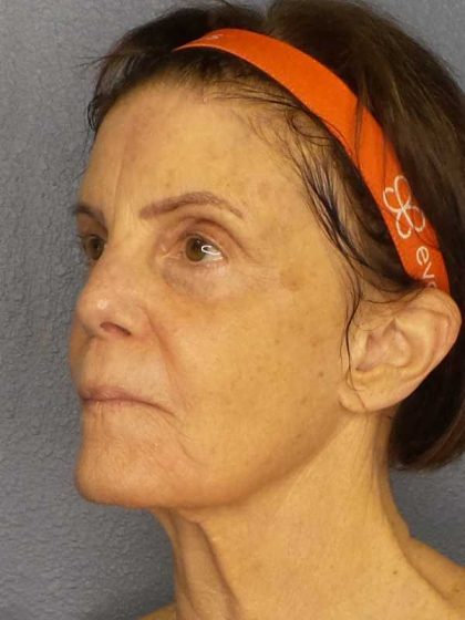 Resurfacing Before & After Patient #12297