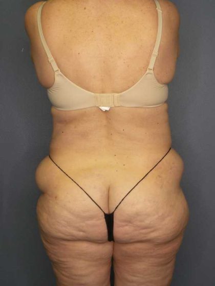 High BMI (Larger Patients) Surgery Before & After Patient #10444