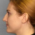 Rhinoplasty Before & After Patient #11013