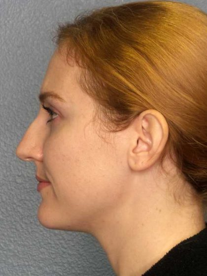 Rhinoplasty Before & After Patient #11013