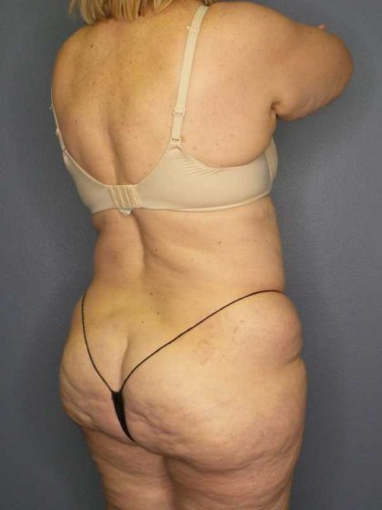 High BMI (Larger Patients) Surgery Before & After Patient #10444