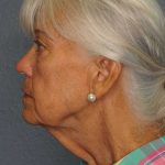 Facelift Before & After Patient #11892