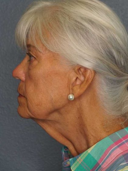 Facelift Before & After Patient #11892