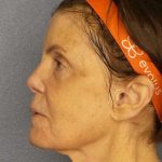 Resurfacing Before & After Patient #12297