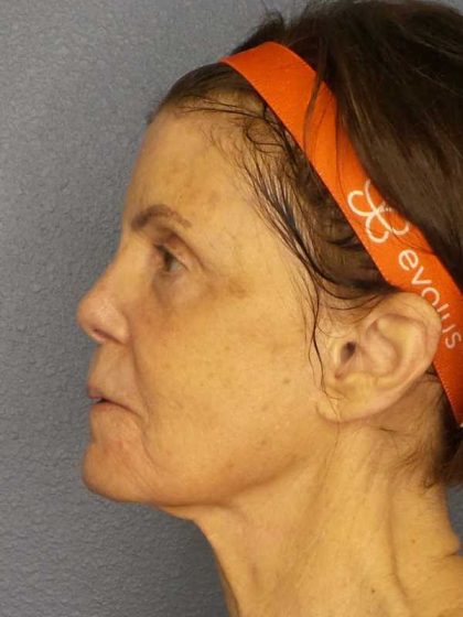 Resurfacing Before & After Patient #12297