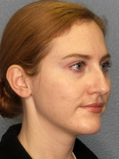 Rhinoplasty Before & After Patient #11013