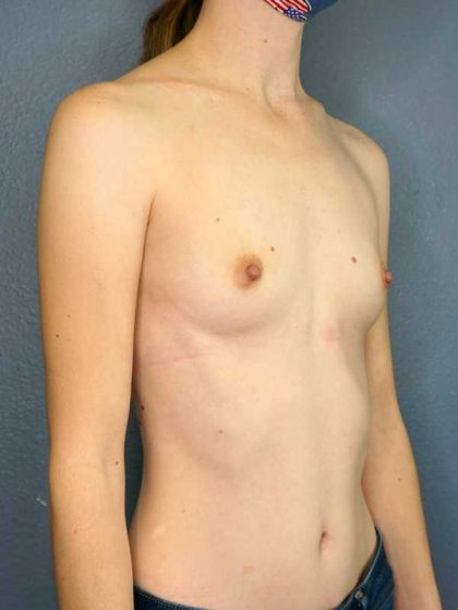 Breast Augmentation Before & After Patient #11498
