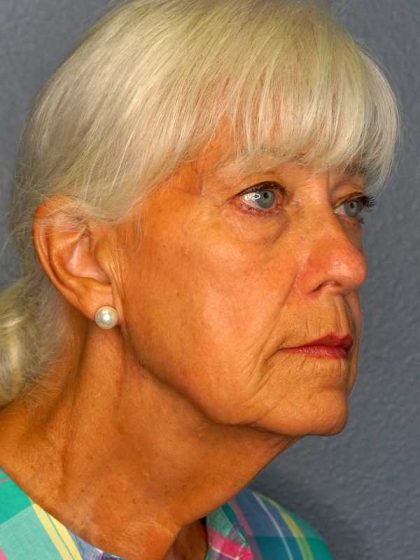Facelift Before & After Patient #11892