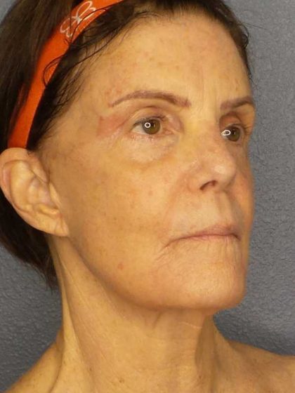 Resurfacing Before & After Patient #12297