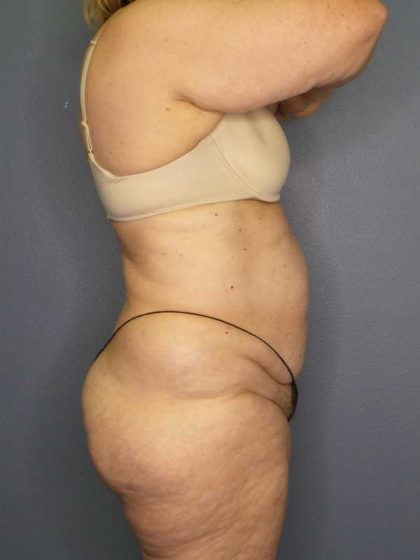 High BMI (Larger Patients) Surgery Before & After Patient #10444