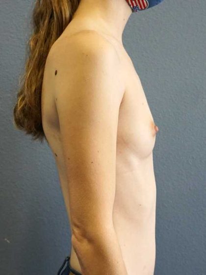 Breast Augmentation Before & After Patient #11498