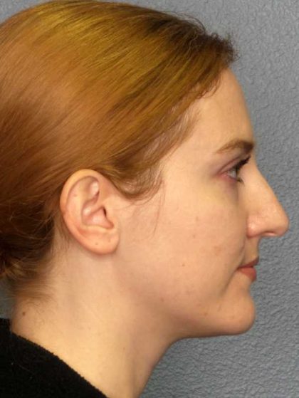 Rhinoplasty Before & After Patient #11013