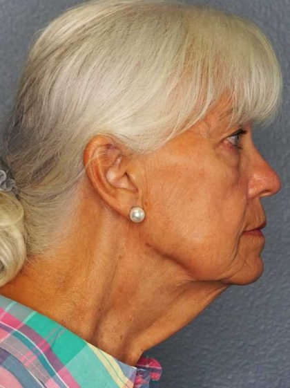 Facelift Before & After Patient #11892