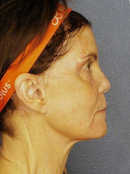Resurfacing Before & After Patient #12297