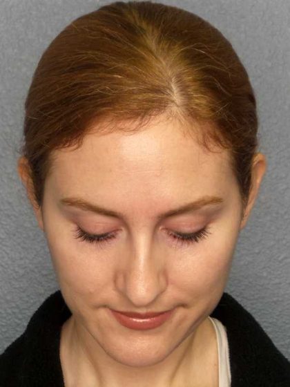 Rhinoplasty Before & After Patient #11013