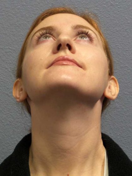 Rhinoplasty Before & After Patient #11013