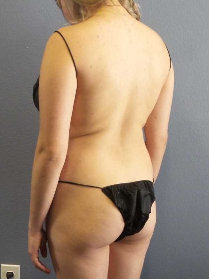 Brazilian Butt Lift Before & After Patient #11305