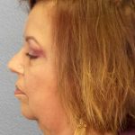 Facelift Before & After Patient #7570