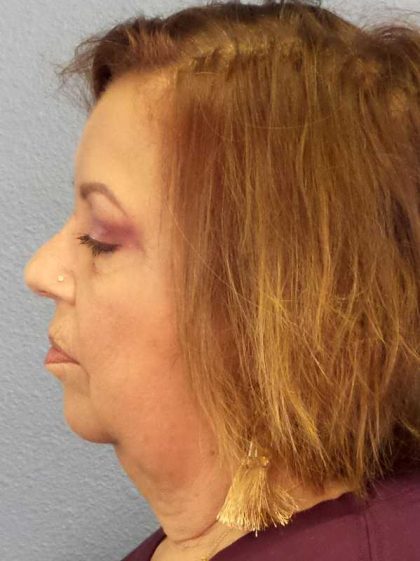 Facelift Before & After Patient #7570